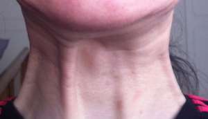 aging neck before treatment